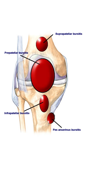 bursitis treatment seattle, bellevue, wa