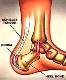 achilles tendon bellevue wa